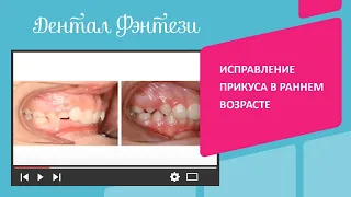 😬 Ортодонтия у детей: исправление прикуса в раннем возрасте