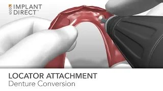 LOCATOR Attachment Chairside Denture Conversion