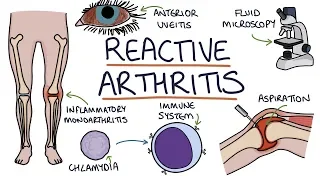 Understanding Reactive Arthritis