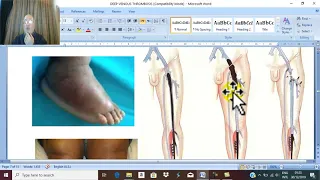 Venous Disorders in English 4 ( Deep venous thrombosis , clinical picture ) , by Dr.Wahdan