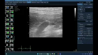 IQ 63  ADRENOMEGALY, BILATERAL , ELASTOGRAPHY, ECGOPAC ANALYSIS,