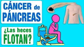 El cáncer de páncreas ¿hace flotar las heces?