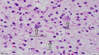 Diffuse Astrocytoma IDH mutant - Adventures in Neuropathology