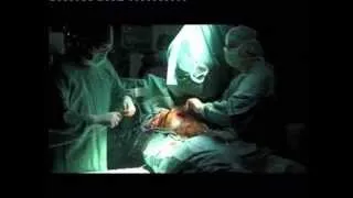 Операция Замороженный хобот слона протезом Gelweave Siena
