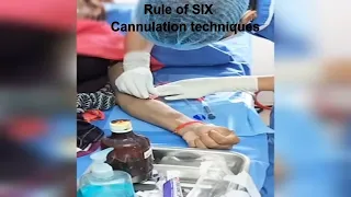 AVF Cannulation techniques | Dialysis patient cannulation #dcdc #ttt
