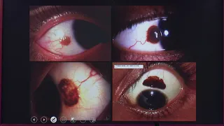 AIOC2020 GP127 T3 Dr Santosh G Honavar Pigmented tumors of the conjunctiva   What is hot and what is