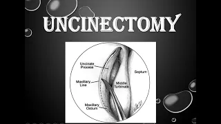 UNCINECTOMY