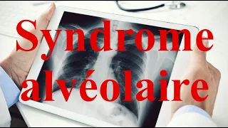 Syndrome alvéolaire