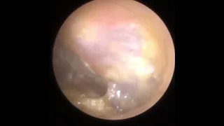 781 - Squelchy Ear Wax Removal off Eardrum