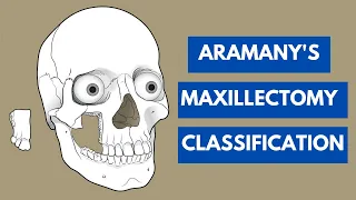 Aramany's Classification of Maxillectomy Defects