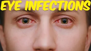 Eye Infections: How to Cure Eye Infection in 24 Hours?