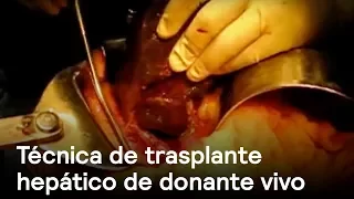 Técnica de trasplante hepático de donante vivo