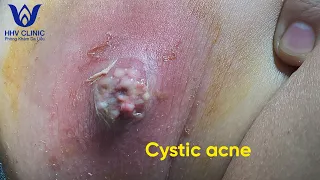 Điều trị mụn u nang, mụn áp xe - Treat cystic acne and abscesses tại HHV Clinic | Đỗ Thu Hiền |