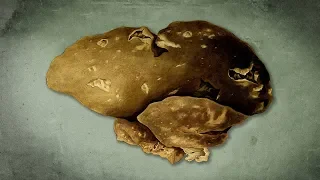 A Student Ate Leftover Potato Salad For Lunch. This Is What Happened To Her Liver.