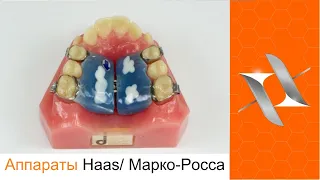 Ортодонтический аппарат Haas/ Марко – Росса. Оrthodontic appliance.