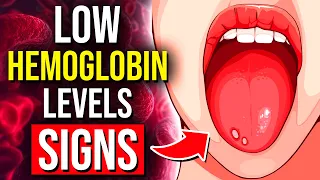 9 Alarming Signs Of Low Hemoglobin You CANNOT Ignore