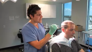 Day 11 Patient Follow-up - Natural Transplants, Hair Transplant Miami Florida (Mohamad)