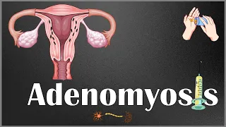 Adenomyosis :- Definition, Causes, Risk Factors, Signs & Symptoms, Diagnosis & Treatment