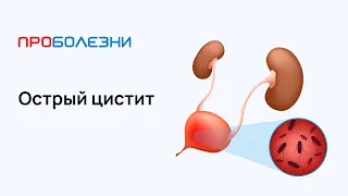 Острый цистит