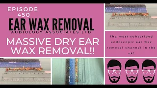 MASSIVE DRY EAR WAX REMOVAL - EP450