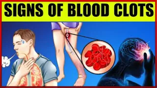 The Top 6 Crucial Warning Signs of Blood Clots That Could Save Your Life!Unveiling the Silent Threat