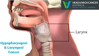 Hypopharyngeal & Laryngeal Cancer (throat) - What Is It? Symptoms & Treatment? Head & Neck Cancer