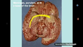 CNS Infections