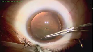 Retinitis pigmentosa Cataract