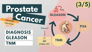 Prostate Cancer | Symptoms, Diagnosis, Staging, Grading | Overview for Med Students