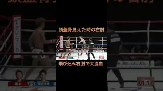 現役生活の中で頭蓋骨が見えた肘もらったの2回目。