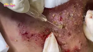 Alia's Beauty 114 Blackheads & Milia, Big Cystic Acne Blackheads Extraction Whiteheads Removal