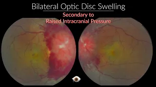 Papilloedema - Optic Nerve swelling