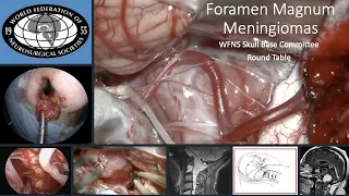 WFNS Skull Base Committee round table on Foramen Magnum Meningiomas