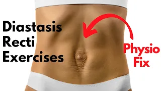 How to START Diastasis Recti Exercises that FIX YOUR GAP | PHYSIO GUIDED Abdo Separation Repair