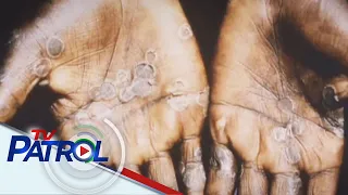 Bilang ng monkeypox cases posibleng madagdagan pa: WHO | TV Patrol