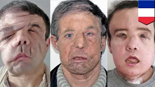French man undergoes second face transplant in world first  - TomoNews