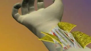 Hand Transplant Surgical Procedure Animation