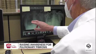 New drug slows scaring of the lungs due to pulmonary fibrosis