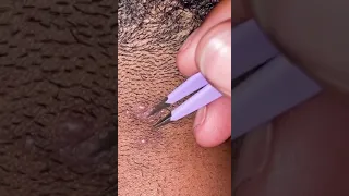 Ingrown hair collections