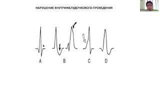 ЭКГ новорожденных. Часть 3