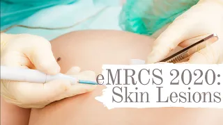 eMRCS 2020: Skin Lesions