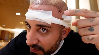 Meine ZWEITE Haartransplantation in der Türkei
