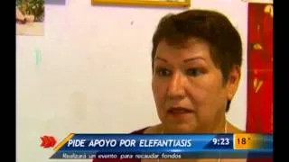 Las Noticias - Pide apoyo por elefantiasis