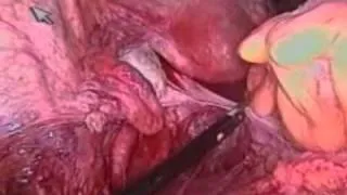 Laparoscopic Ileocolic Resection for Crohn's Disease Complicated by Fistulas