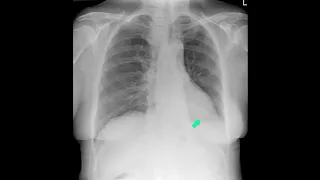 Left lower lobe collapse - the most divisive of all radiology exam cases?