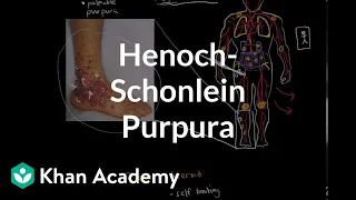 Henoch-Schonlein purpura | Circulatory System and Disease | NCLEX-RN | Khan Academy