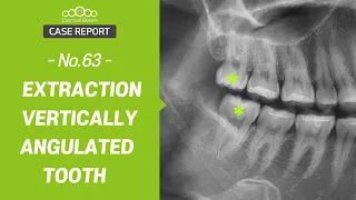 [MULTI_SUB] Extraction of vertically angulated tooth (#18,48) [Dr. Cho Yongseok]