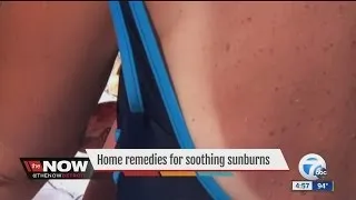 Best home remedies for sunburn