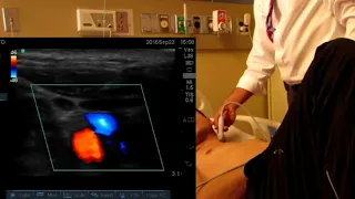 Angle dependence of Color Doppler