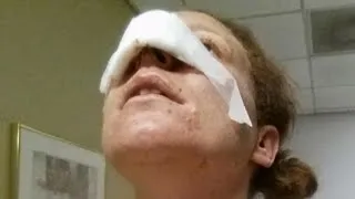 Woman Gets New Nose After Her Boyfriend Allegedly Bit Hers Off